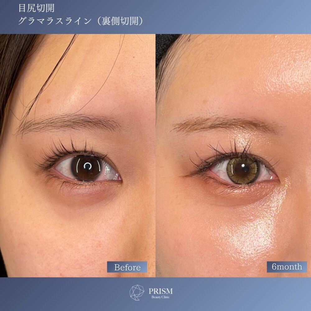 目尻切開＋たれ目形成(グラマラスライン) 裏側切開 パーフェクト