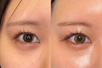 目尻切開＋たれ目形成(グラマラスライン) 裏側切開 パーフェクト