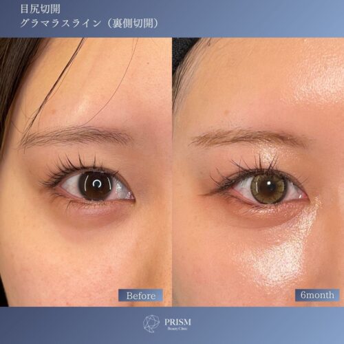 目尻切開+たれ目形成(グラマラスライン) 裏側切開 パーフェクト 目尻切開+たれ目形成(グラマラスライン) 裏側切開 パーフェクト