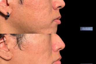 サブシジョン＋ヒアルロン酸注射