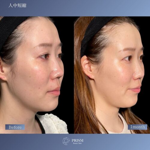 人中短縮