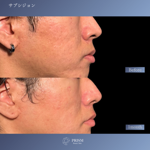 サブシジョン＋ヒアルロン酸注射