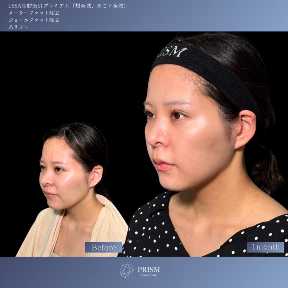 エルサ脂肪吸引プレミアム(頬・顎下)+メーラーファット除去+ジョールファット除去+糸リフト(ウルトラソフト) エルサ脂肪吸引プレミアム(頬・顎下)+メーラーファット除去+ジョールファット除去+糸リフト(ウルトラソフト)