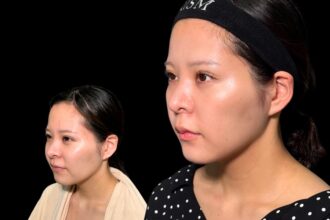 エルサ脂肪吸引プレミアム(頬・顎下)+メーラーファット除去+ジョールファット除去+糸リフト(ウルトラソフト) エルサ脂肪吸引プレミアム(頬・顎下)+メーラーファット除去+ジョールファット除去+糸リフト(ウルトラソフト)