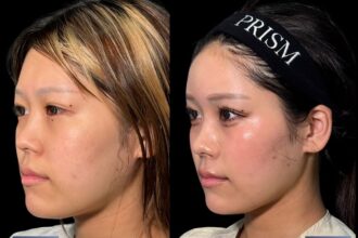 バッカルファット除去＋ジョールファット除去＋ヒアルロン酸注射（貴族）