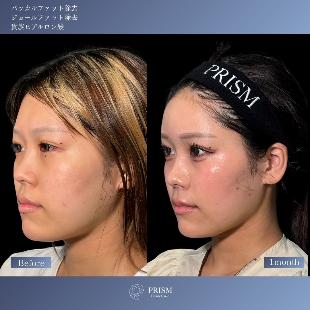 ヒアルロン酸注射 < 新宿・町田の美容外科・美容皮膚科｜PRISM Beauty
