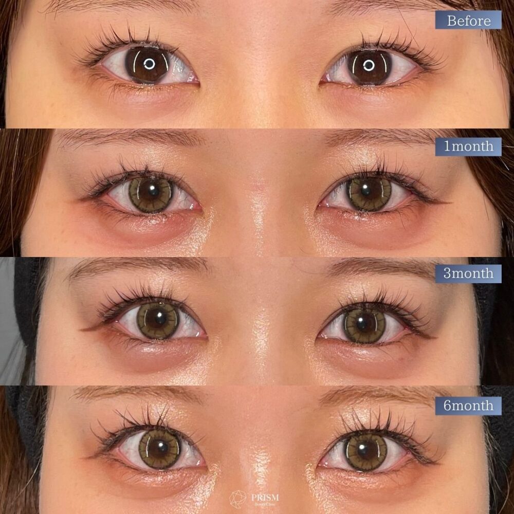 目尻切開＋たれ目形成(グラマラスライン) 裏側切開 パーフェクト