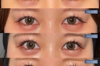 目尻切開＋たれ目形成(グラマラスライン) 裏側切開 パーフェクト