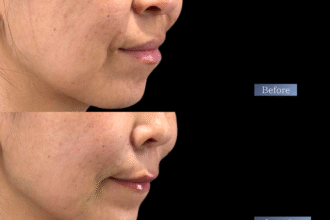 ジュブゼン（ほうれい線）