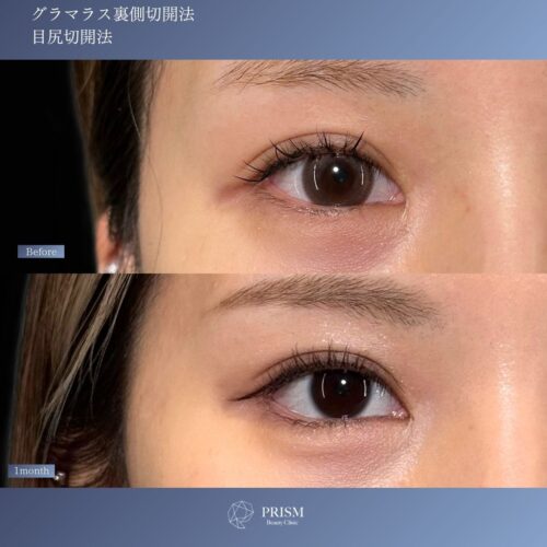 目尻切開＋たれ目形成(グラマラスライン) 裏側切開 パーフェクト