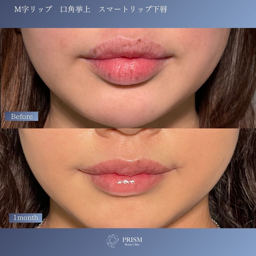 M字リップ形成術 < 新宿・町田の美容外科・美容皮膚科｜PRISM Beauty