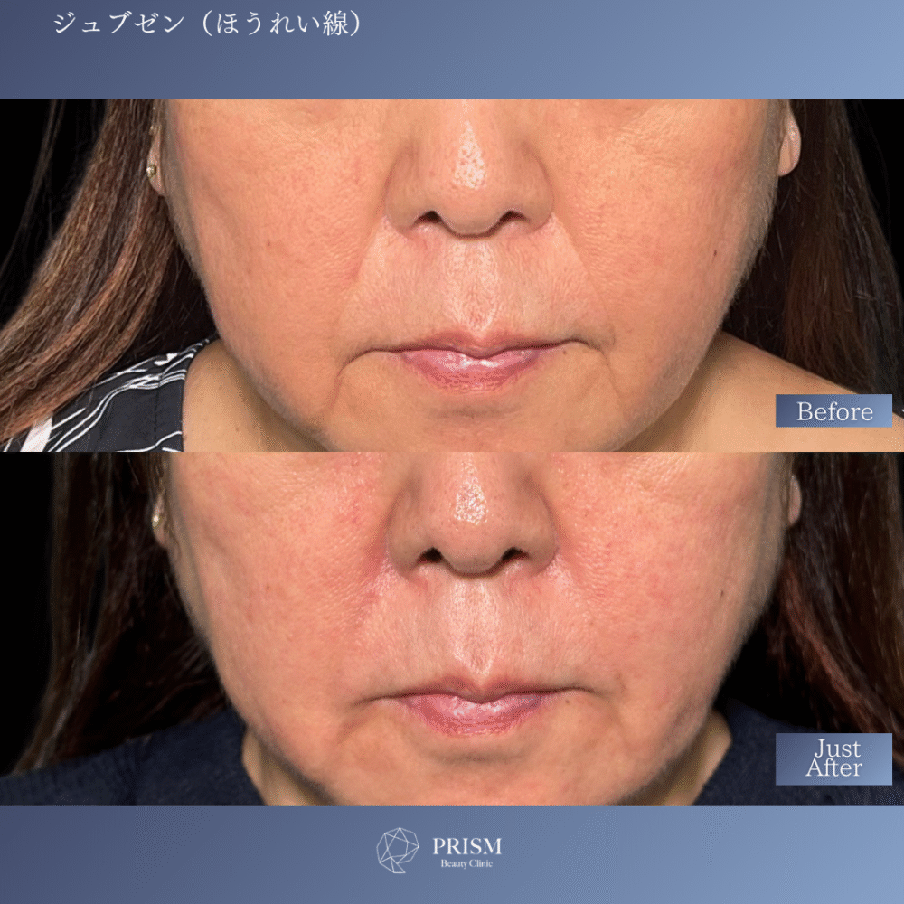 ジュブゼン（ほうれい線）