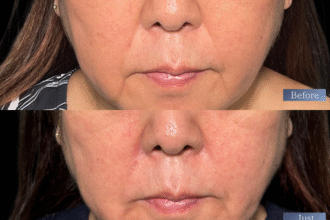 ジュブゼン（ほうれい線）