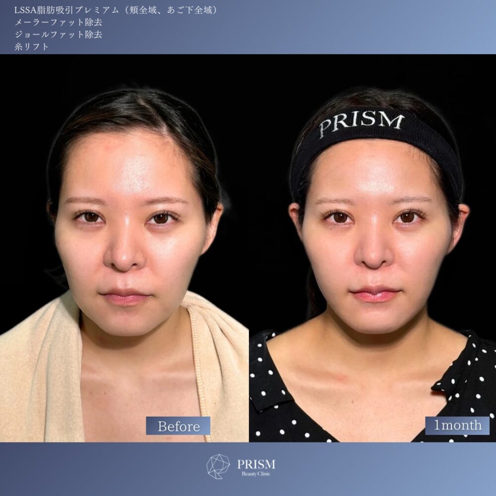 エルサ脂肪吸引プレミアム(頬・顎下)+メーラーファット除去+ジョールファット除去+糸リフト(ウルトラソフト) エルサ脂肪吸引プレミアム(頬・顎下)+メーラーファット除去+ジョールファット除去+糸リフト(ウルトラソフト)