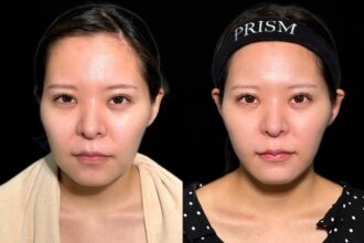 エルサ脂肪吸引プレミアム(頬・顎下)+メーラーファット除去+ジョールファット除去+糸リフト(ウルトラソフト) エルサ脂肪吸引プレミアム(頬・顎下)+メーラーファット除去+ジョールファット除去+糸リフト(ウルトラソフト)