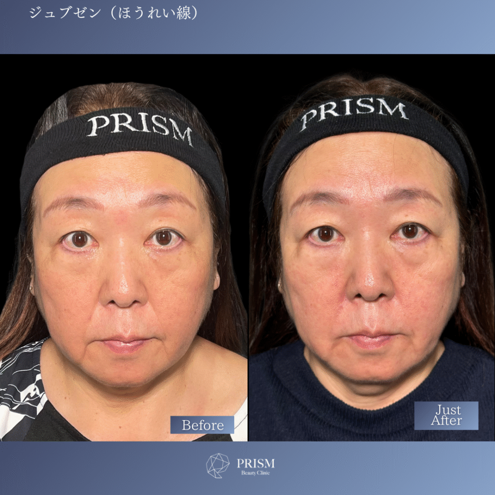 ジュブゼン（ほうれい線）