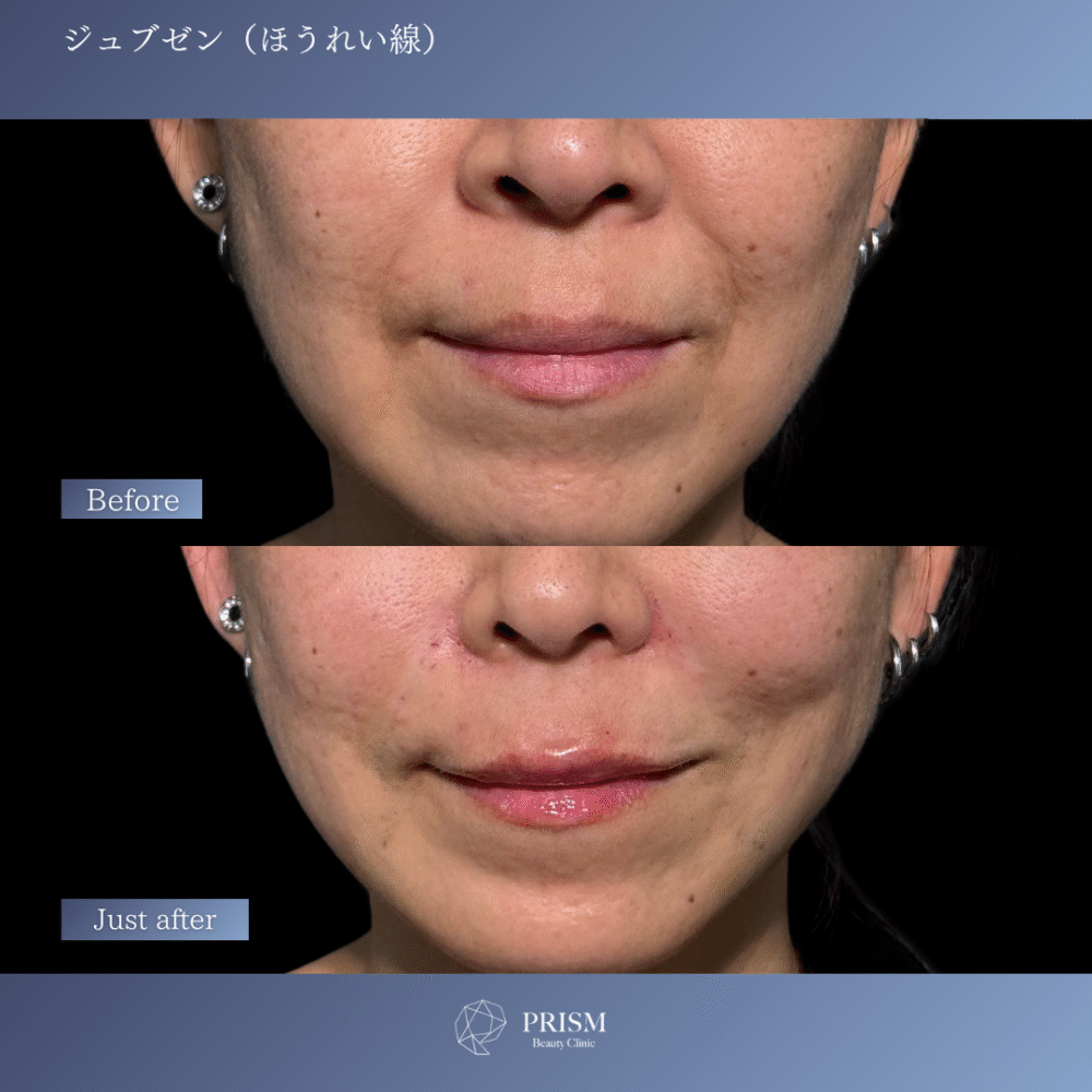 ジュブゼン（ほうれい線）
