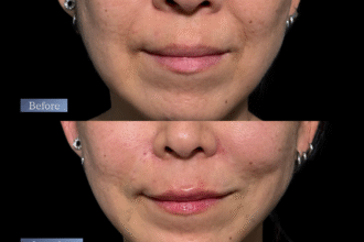 ジュブゼン（ほうれい線）