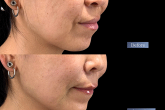 ジュブゼン（ほうれい線）