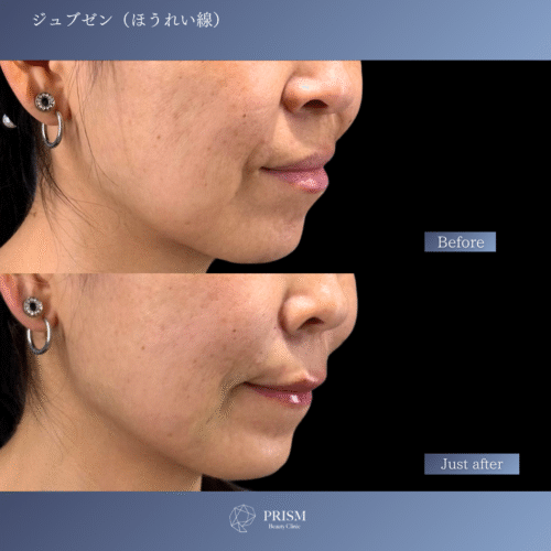 ジュブゼン(ほうれい線) ジュブゼン(ほうれい線)