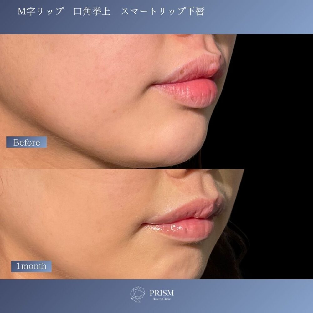 口角挙上+M字リップ+スマートリップ(下唇) 口角挙上+M字リップ+スマートリップ(下唇)