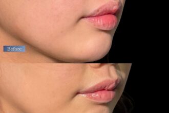 口角挙上＋M字リップ＋スマートリップ（下唇）