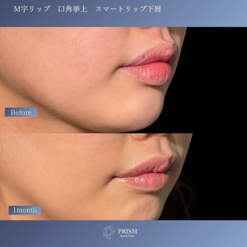 口角挙上＋M字リップ＋スマートリップ（下唇）