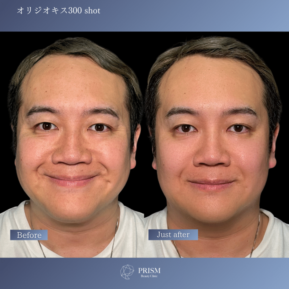 オリジオKISS（RF600ショット＋HIFU400ショット）