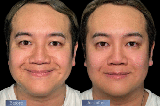 オリジオKISS（RF600ショット＋HIFU400ショット）