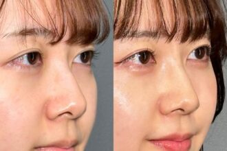 鼻先リフト(鼻尖形成) 3D法+ 小鼻縮小(鼻翼縮小) 内側切開法 鼻先リフト(鼻尖形成) 3D法+ 小鼻縮小(鼻翼縮小) 内側切開法