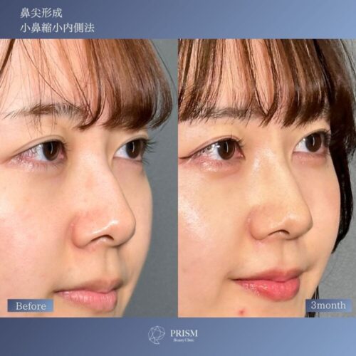 鼻先リフト(鼻尖形成) 3D法+ 小鼻縮小(鼻翼縮小) 内側切開法 鼻先リフト(鼻尖形成) 3D法+ 小鼻縮小(鼻翼縮小) 内側切開法