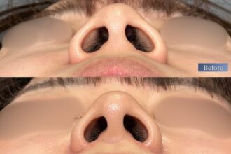 鼻先リフト(鼻尖形成) 3D法+ 小鼻縮小(鼻翼縮小) 内側切開法 鼻先リフト(鼻尖形成) 3D法+ 小鼻縮小(鼻翼縮小) 内側切開法