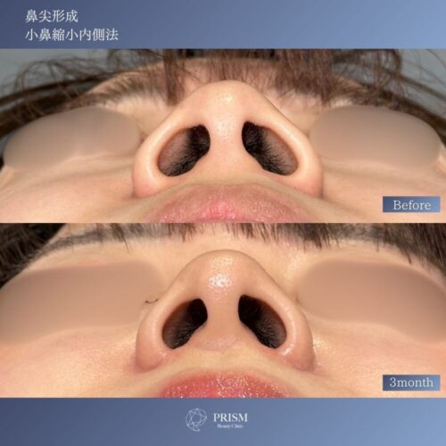 鼻先リフト(鼻尖形成) 3D法+ 小鼻縮小(鼻翼縮小) 内側切開法 鼻先リフト(鼻尖形成) 3D法+ 小鼻縮小(鼻翼縮小) 内側切開法