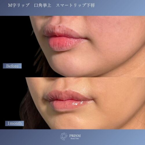 口角挙上＋M字リップ＋スマートリップ（下唇）
