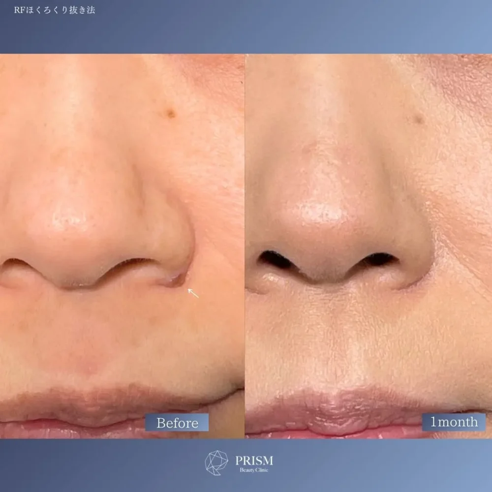 ほくろ除去　RFナイフによるくり抜き法