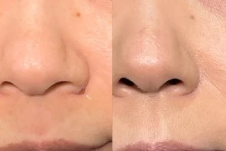 ほくろ除去　RFナイフによるくり抜き法