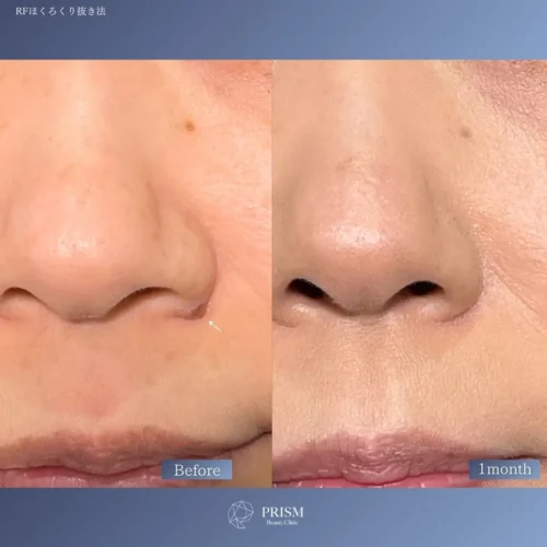 ほくろ除去　RFナイフによるくり抜き法