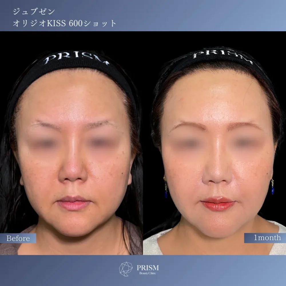 ジュブゼン（ほうれい線）