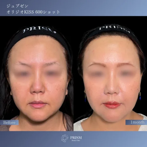 ジュブゼン（ほうれい線）