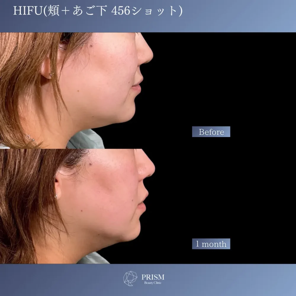 HIFU 頬＋あご下 456ショット
