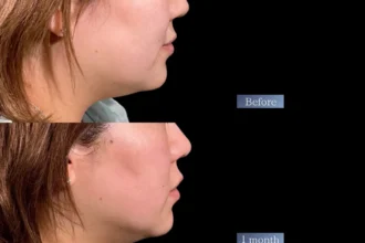 HIFU 頬＋あご下 456ショット