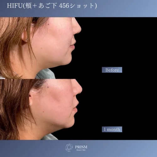 HIFU 頬＋あご下 456ショット