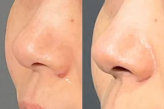 ほくろ除去　RFナイフによるくり抜き法