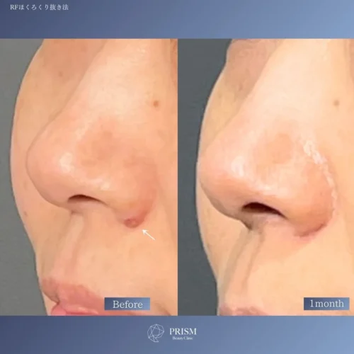 ほくろ除去　RFナイフによるくり抜き法