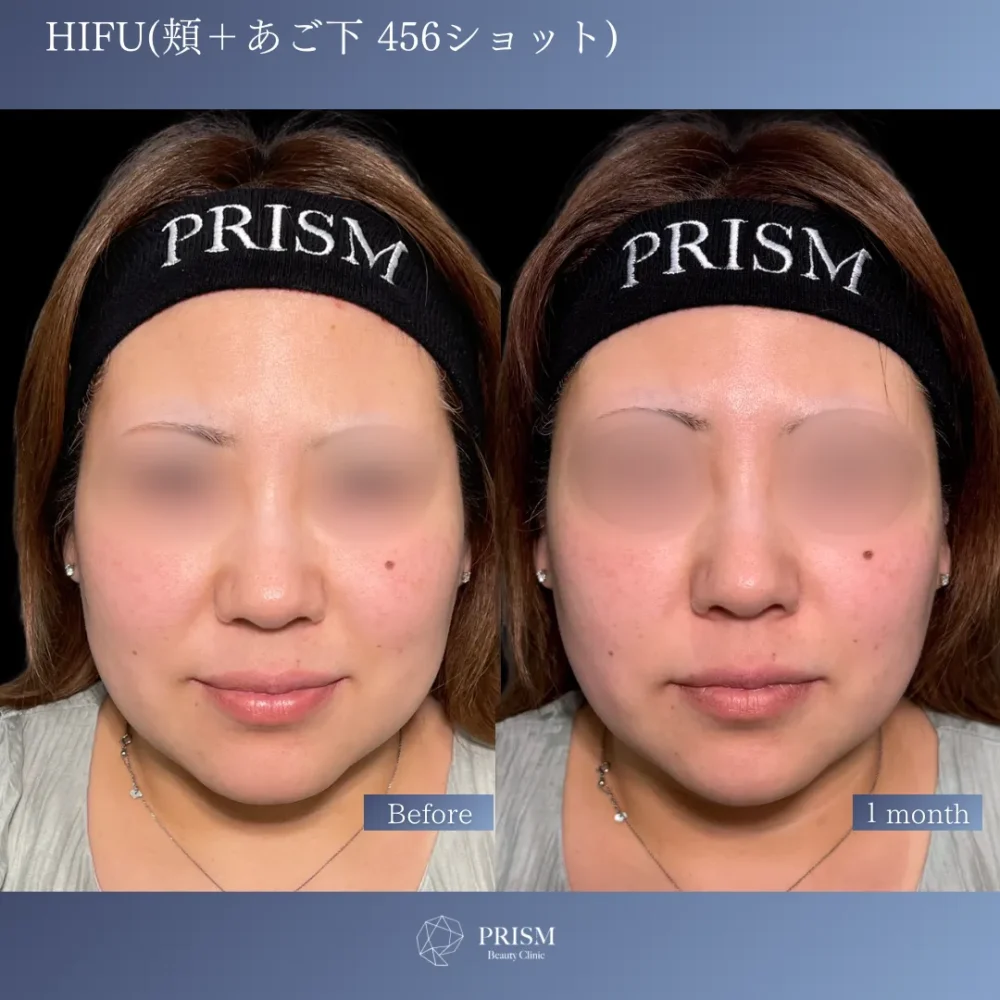 HIFU 頬＋あご下 456ショット