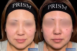 HIFU 頬＋あご下 456ショット