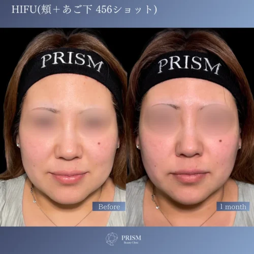 HIFU 頬＋あご下 456ショット