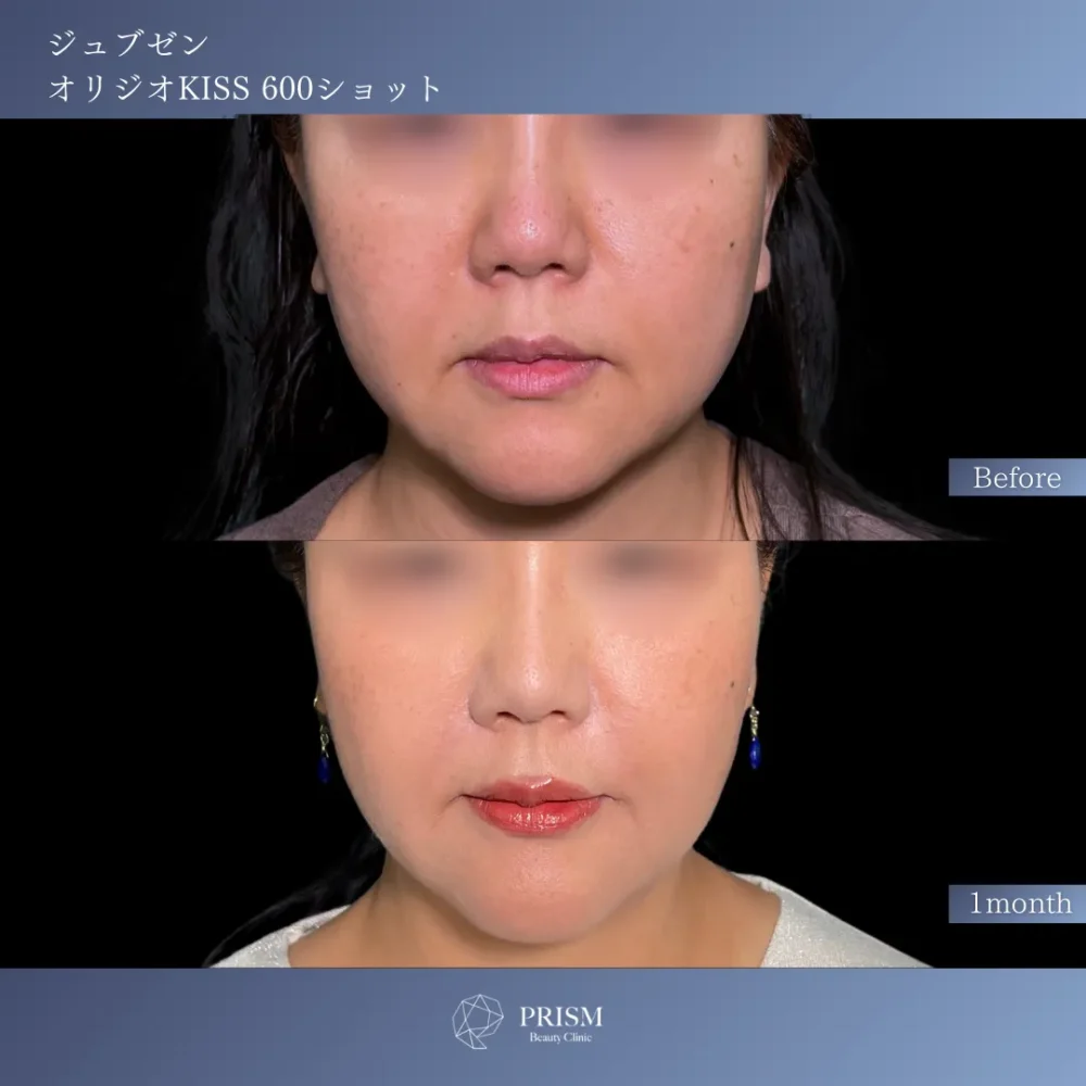 ジュブゼン（ほうれい線）