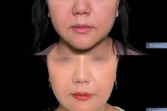 ジュブゼン（ほうれい線）