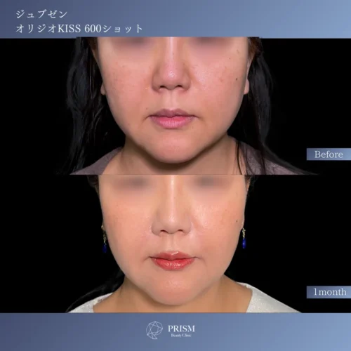 ジュブゼン（ほうれい線）